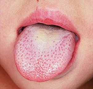 muguet lengua blanca